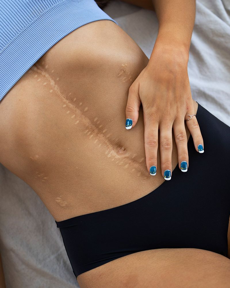 Terapia delle cicatrici, trattamento delle cicatrici, Berlino, Prenzlauer Berg